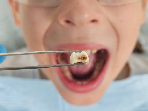 Best Chipped Tooth Repair Near Me  in Summit Hill, PA
